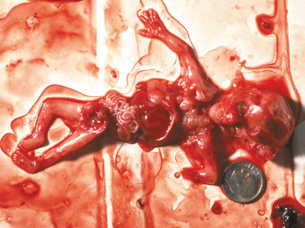 10 Week Abortion (06)