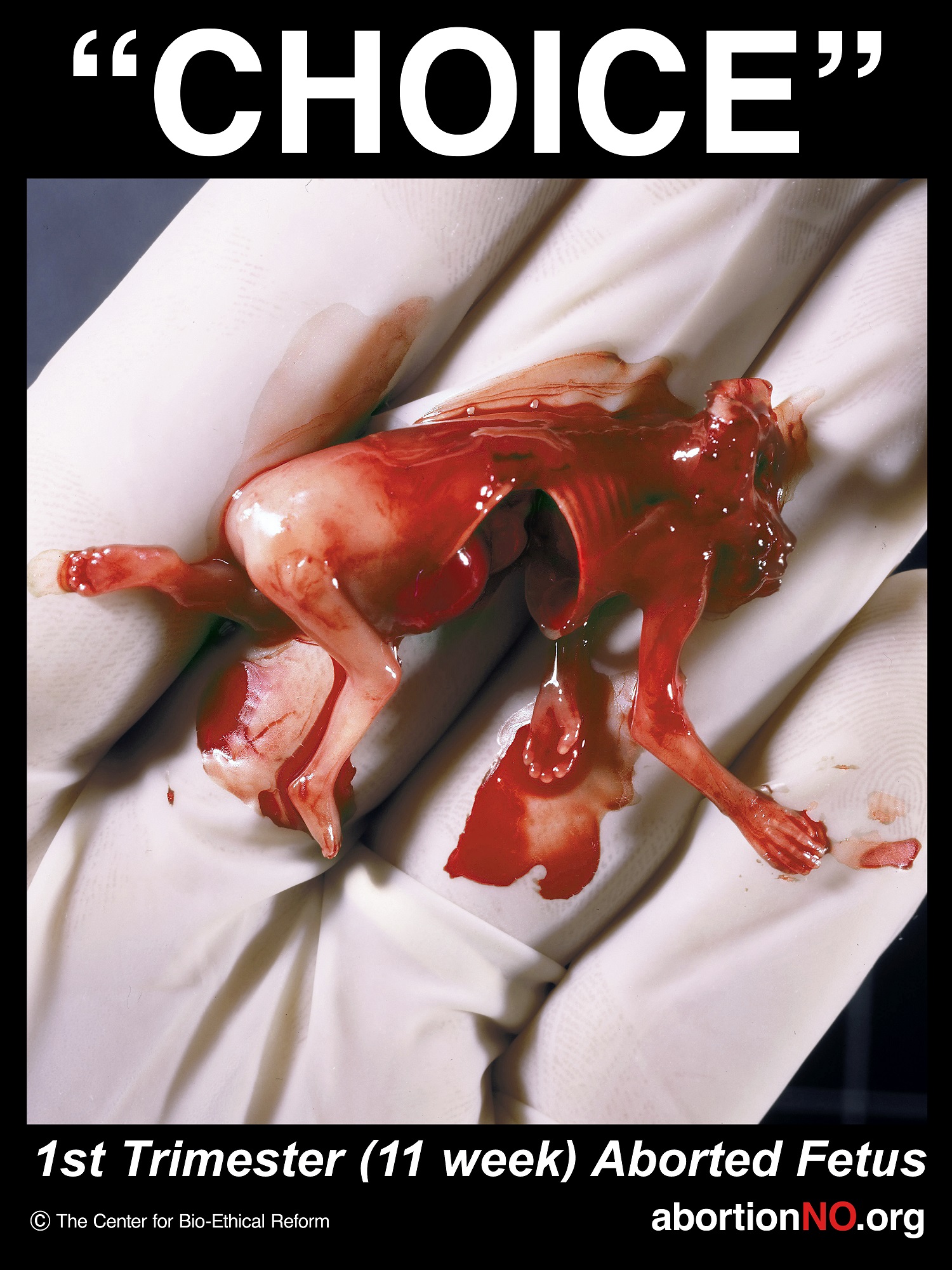 Aborted 11 week baby - decapitated