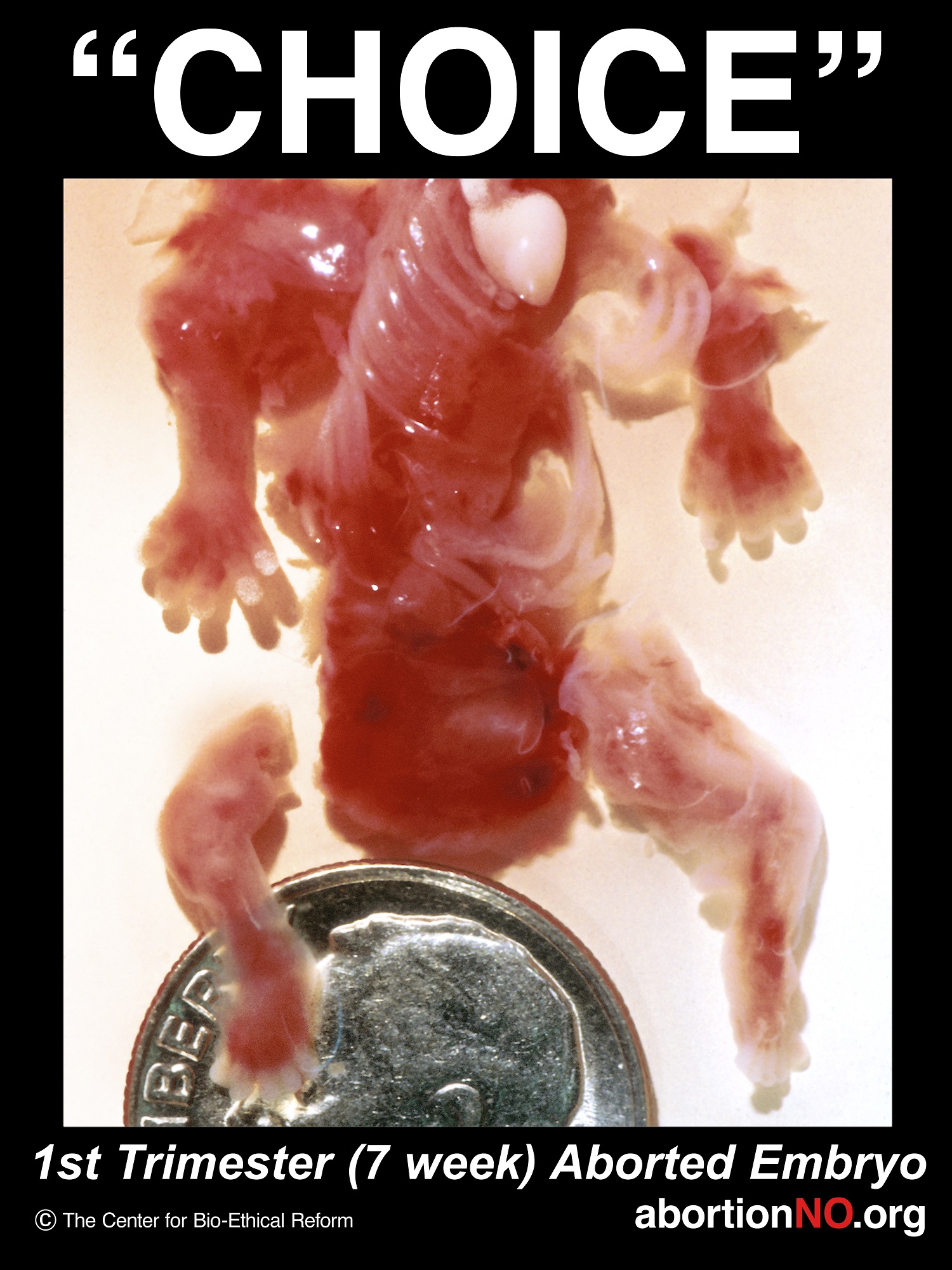 Aborted 07 week baby