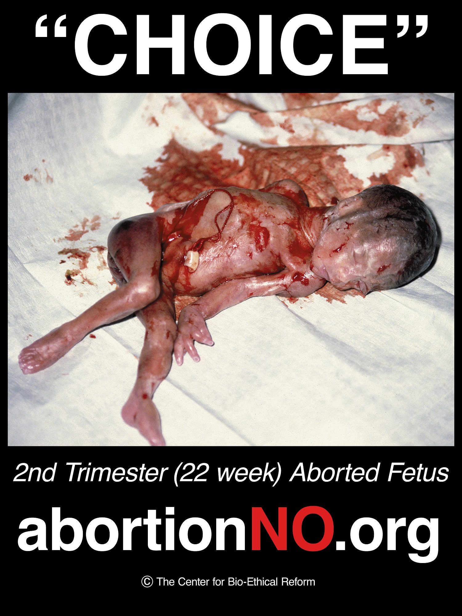 Aborted 22 week baby